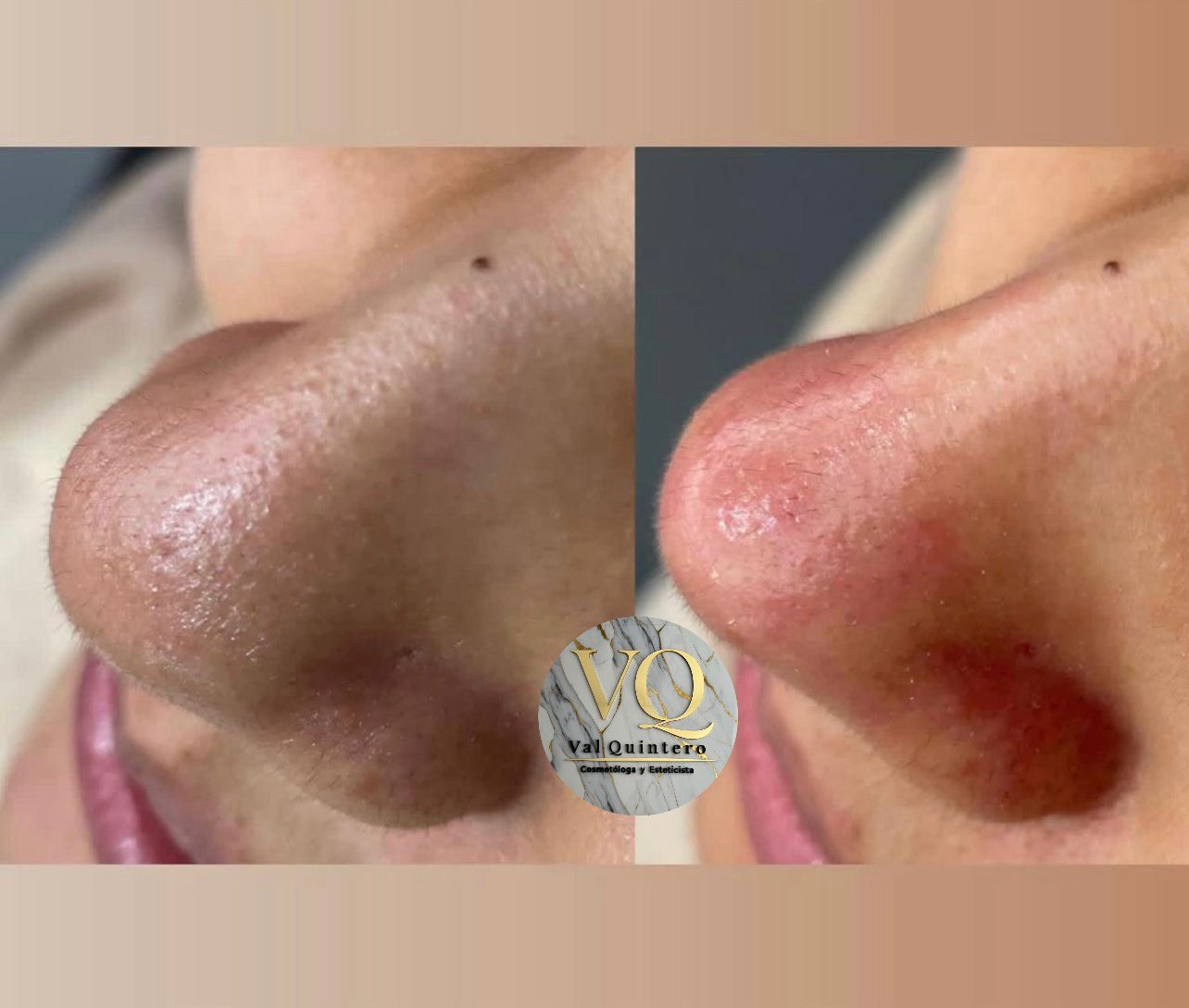 Limpieza Facial Básica + Hidratación - Val Quintero Cosmetología Medellín