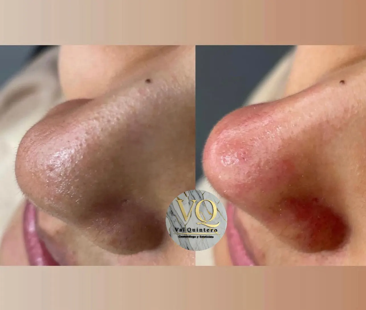 Limpieza Facial Básica + Hidratación - Val Quintero Cosmetología Medellín