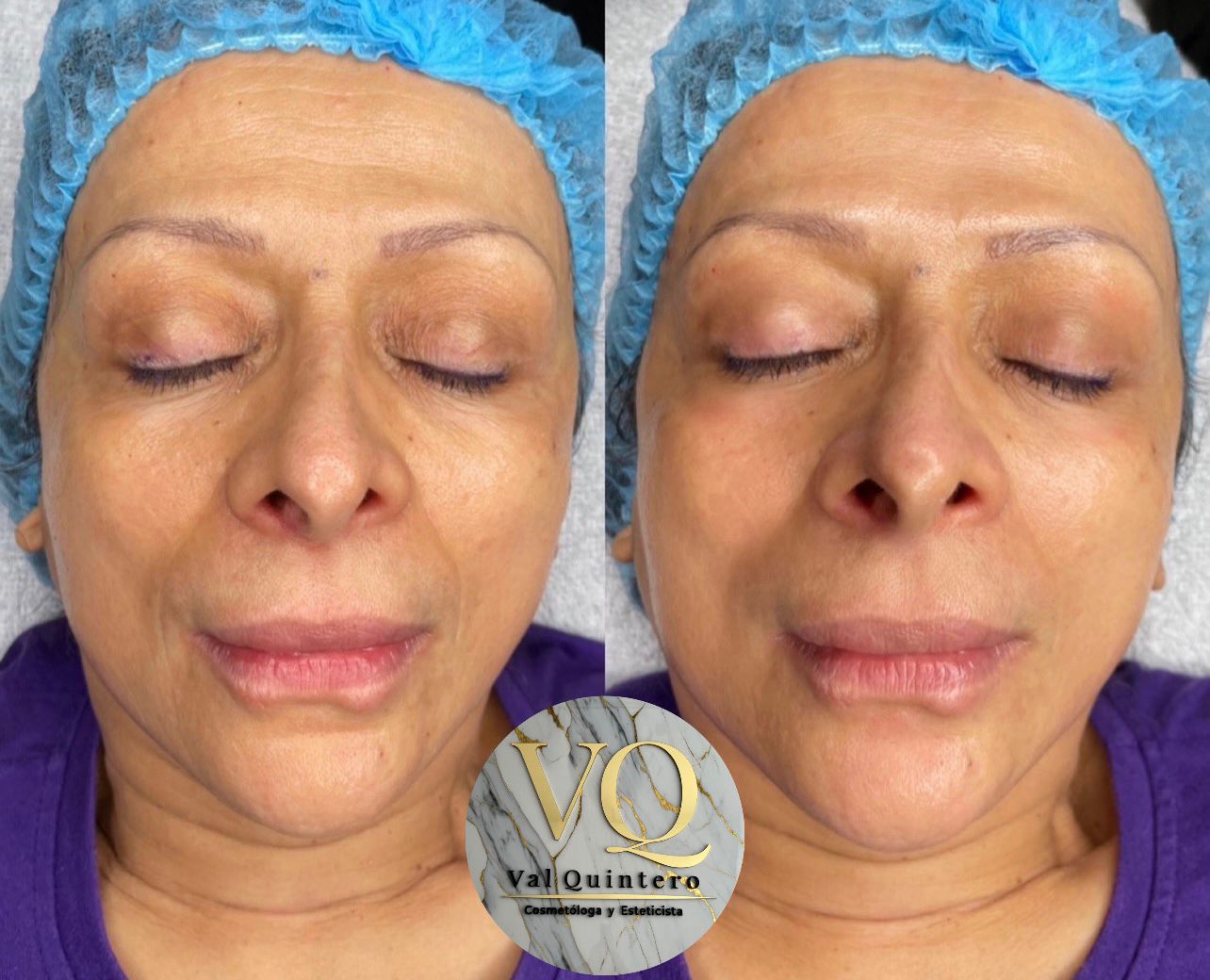 Antiedad - Val Quintero Cosmetología Medellín