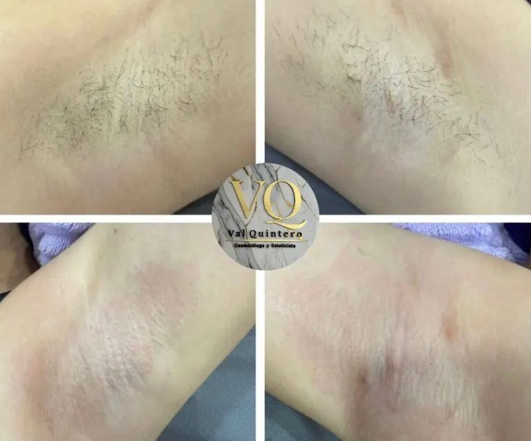 Depilación con cera de axilas con Val Quintero en Bello
