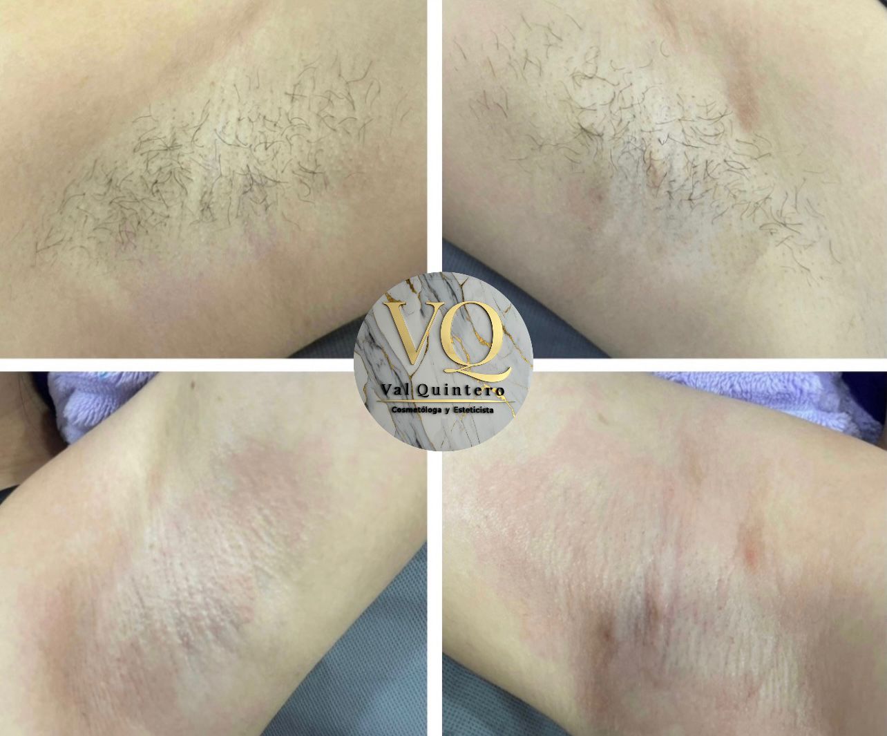 Axilas - Val Quintero Cosmetología Medellín