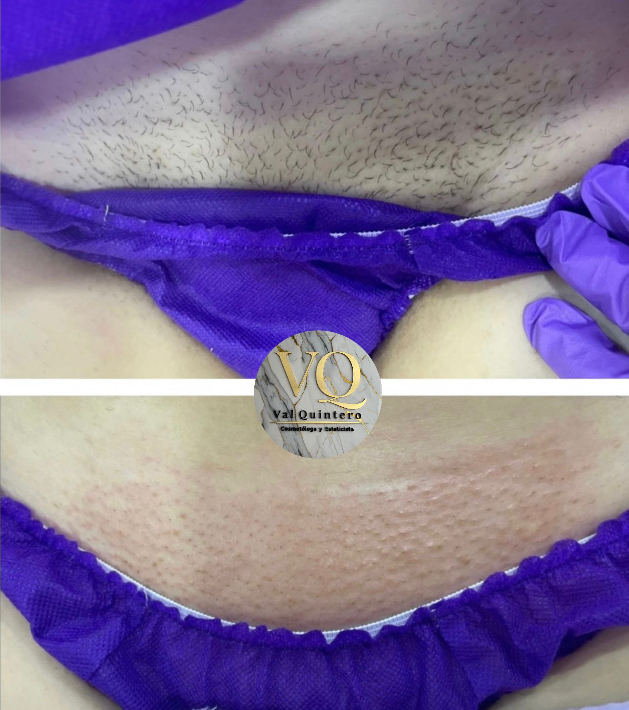 Bikini - Val Quintero Cosmetología Medellín