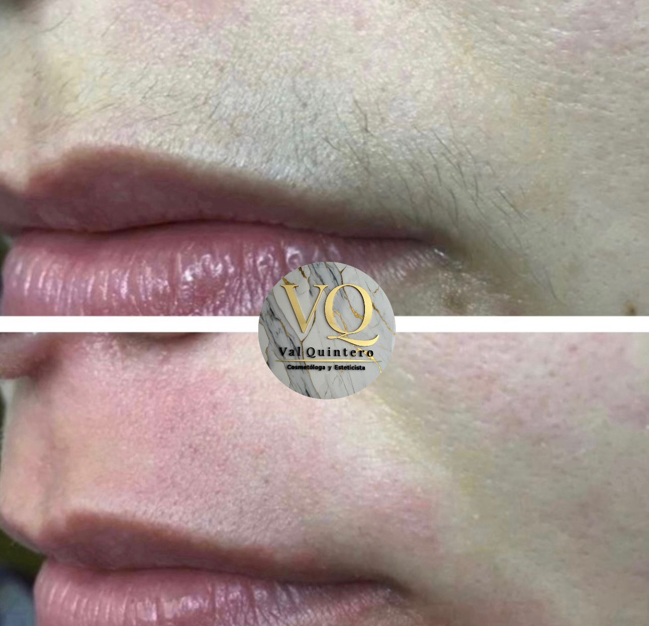 Bigote - Val Quintero Cosmetología Medellín