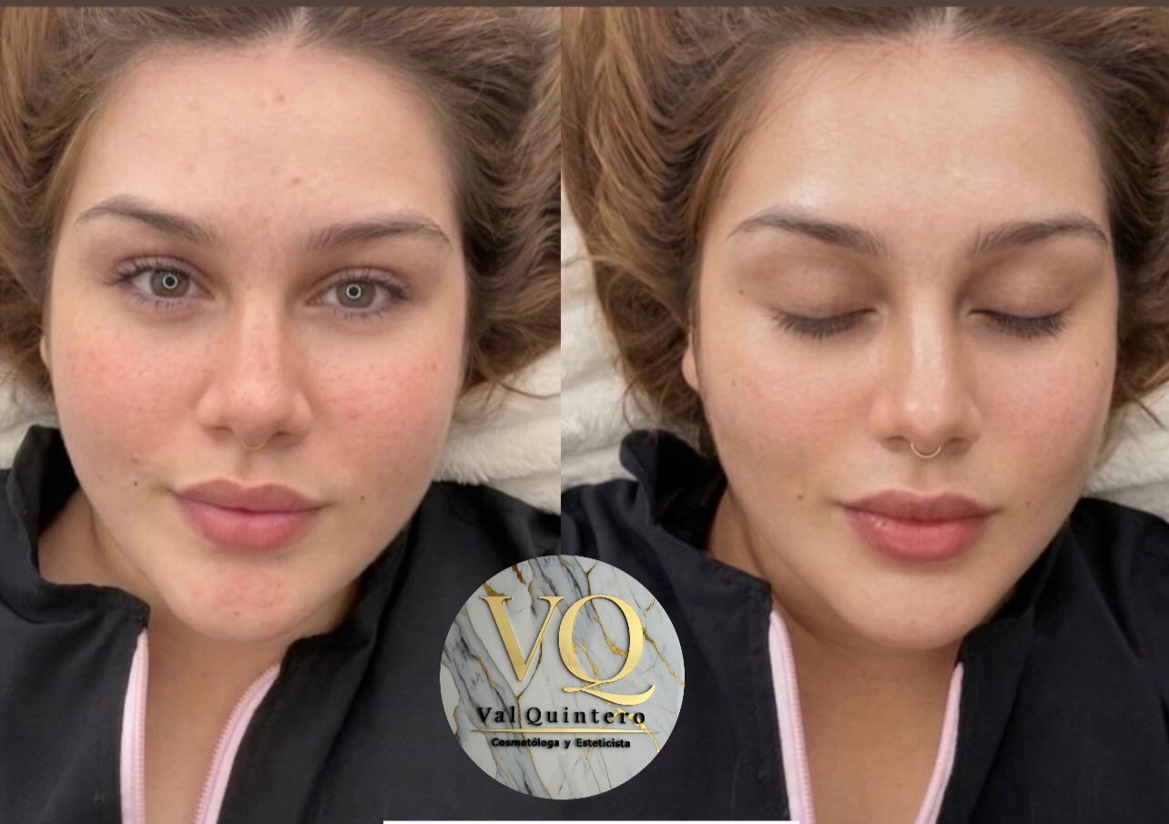 Dermapen + Cóctel Revitalizante - Val Quintero Cosmetología Medellín