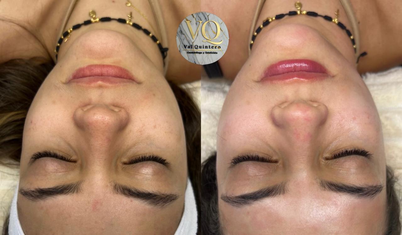 Limpieza Facial + Dermapen - Val Quintero Cosmetología Medellín