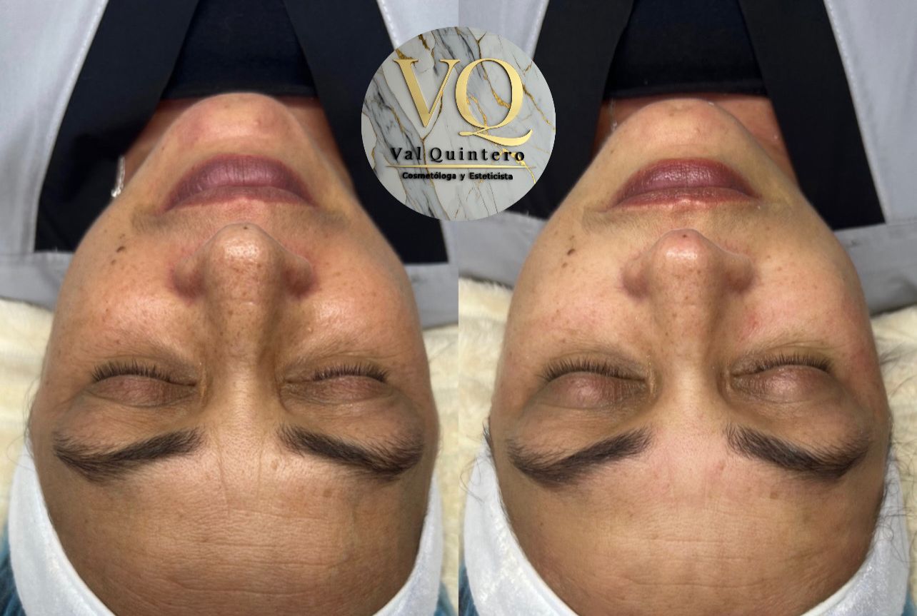 Dermapen + Hialurónico o Vitamina C - Val Quintero Cosmetología Medellín