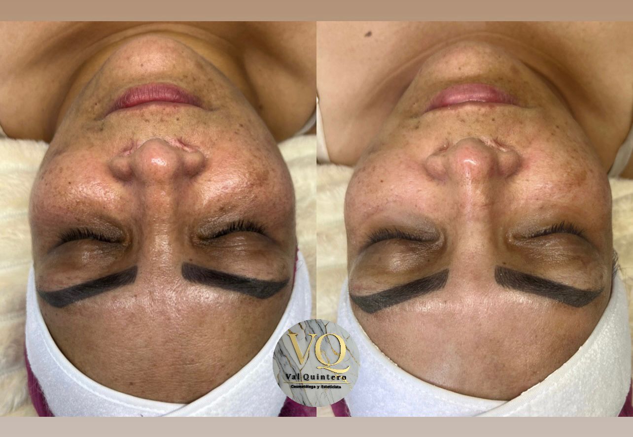Despigmentación Facial - Val Quintero Cosmetología Medellín