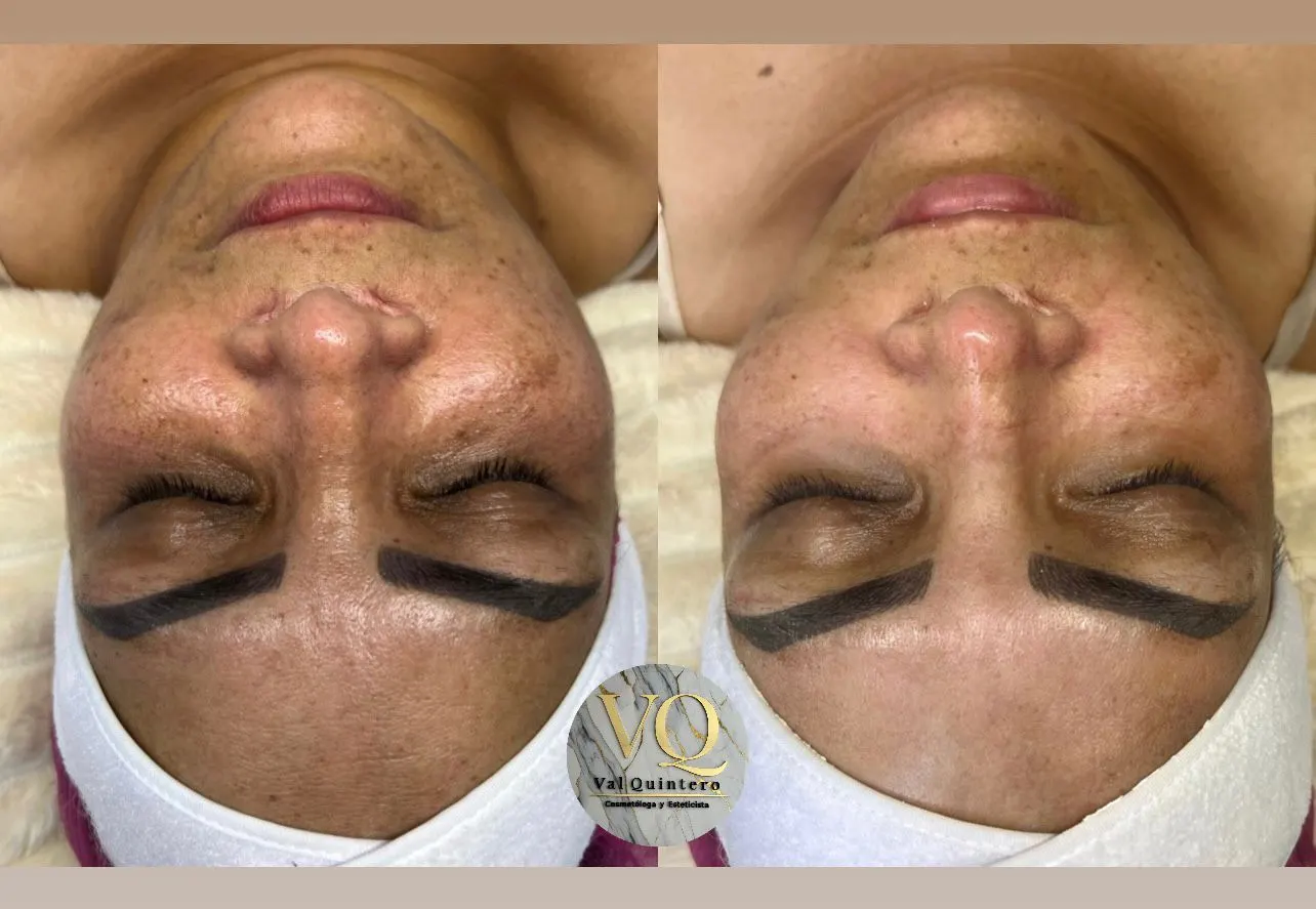 Despigmentación Facial - Val Quintero Cosmetología Medellín