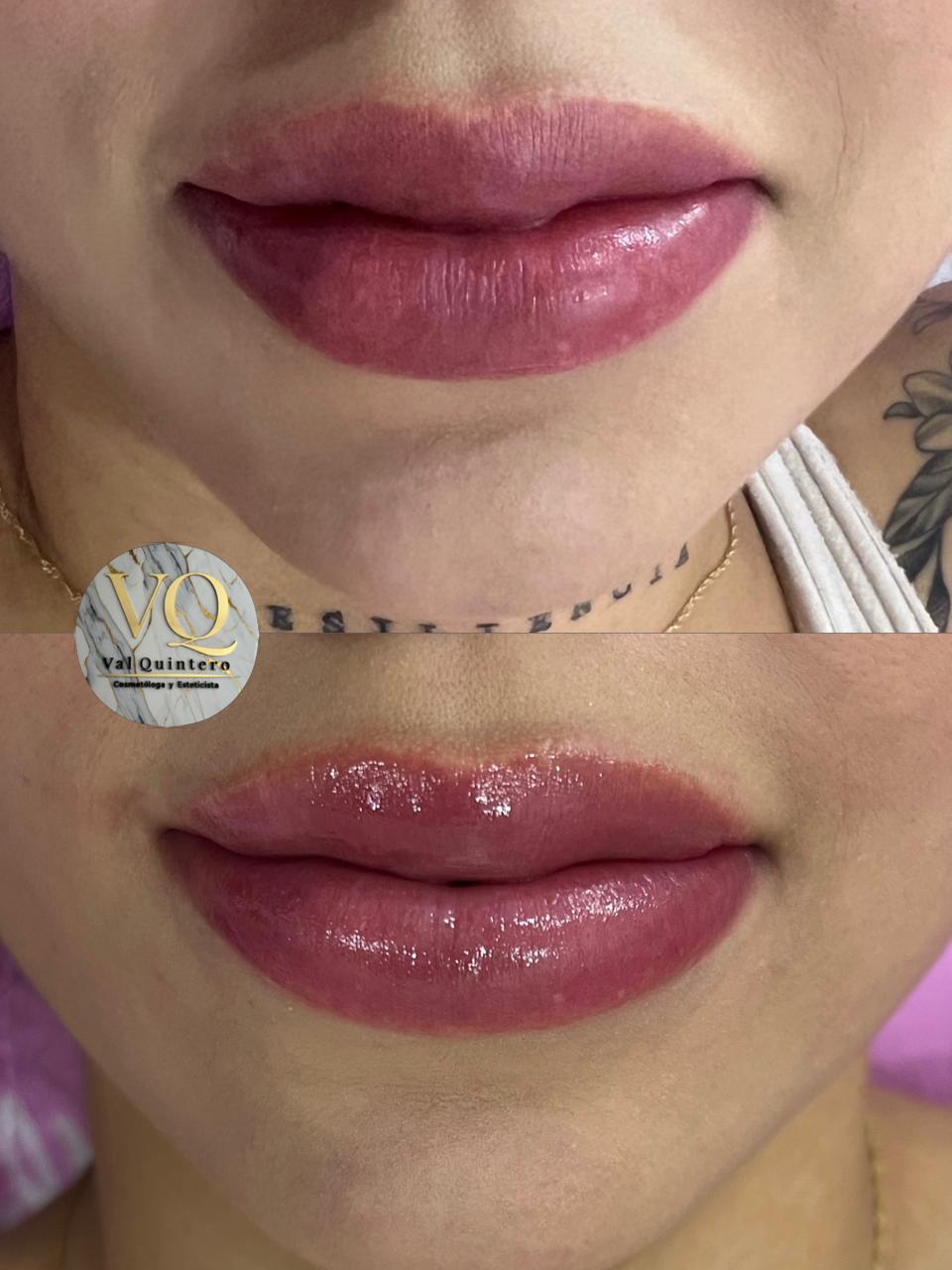 Hidralips - Val Quintero Cosmetología Medellín