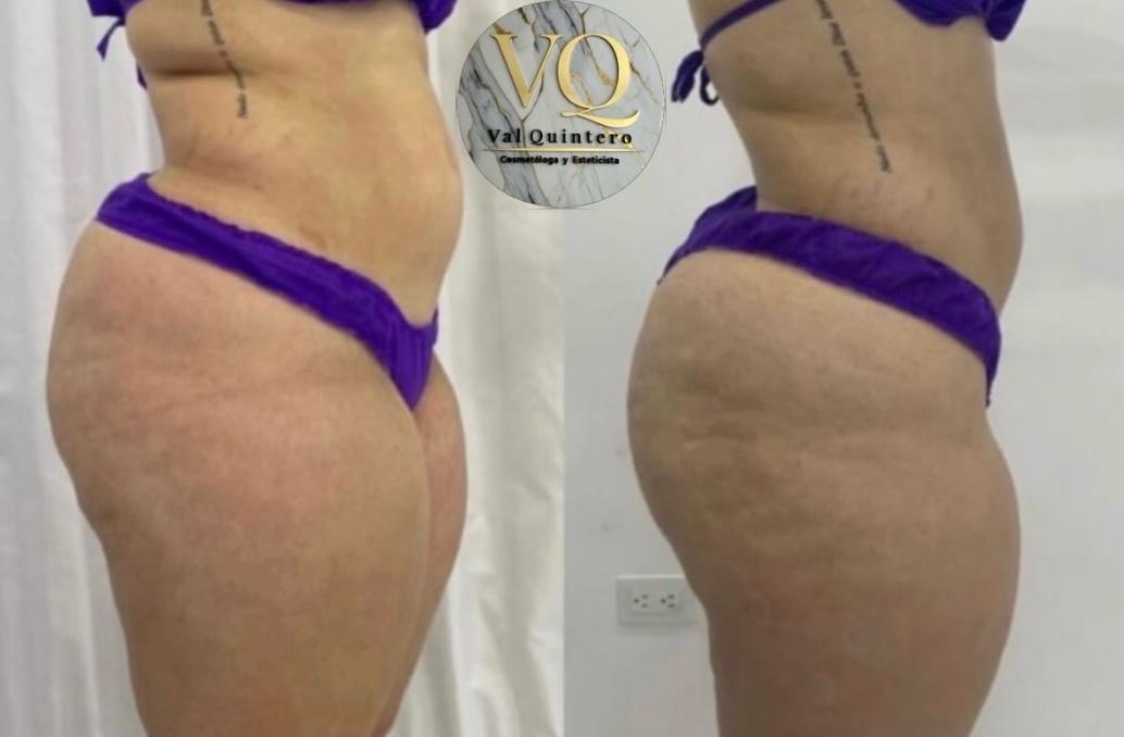 Masajes de Levantamiento de Glúteo - Val Quintero Cosmetología Medellín