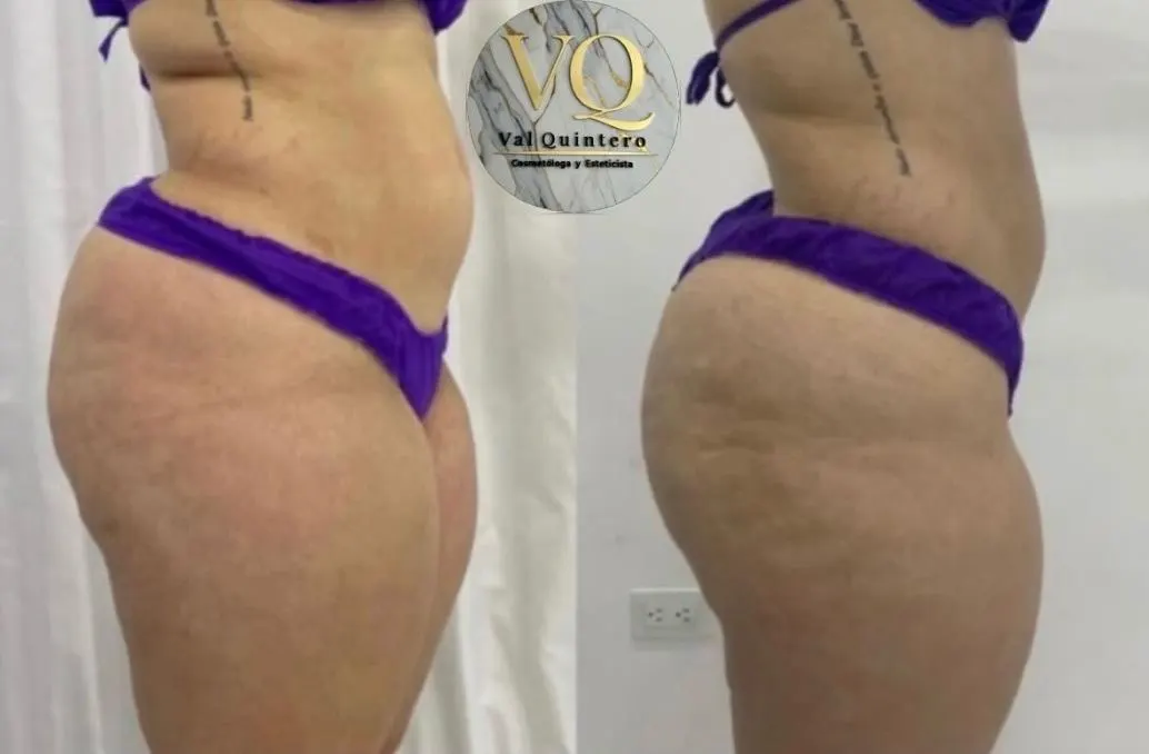 Masajes de Levantamiento de Glúteo - Val Quintero Cosmetología Medellín