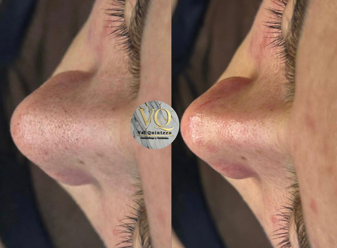 Limpieza Facial Profunda - Val Quintero Cosmetología Medellín