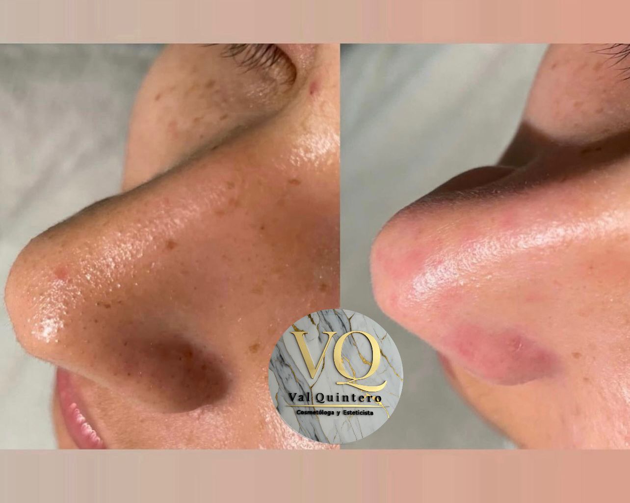 Limpieza Facial Profunda + Microdermoabrasión - Val Quintero Cosmetología Medellín