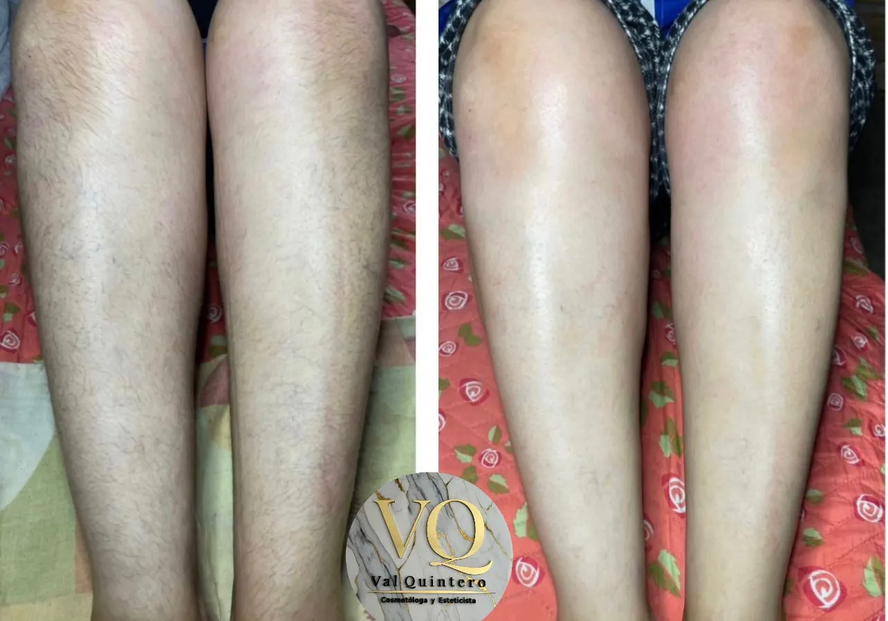 Pierna - Val Quintero Cosmetología Medellín