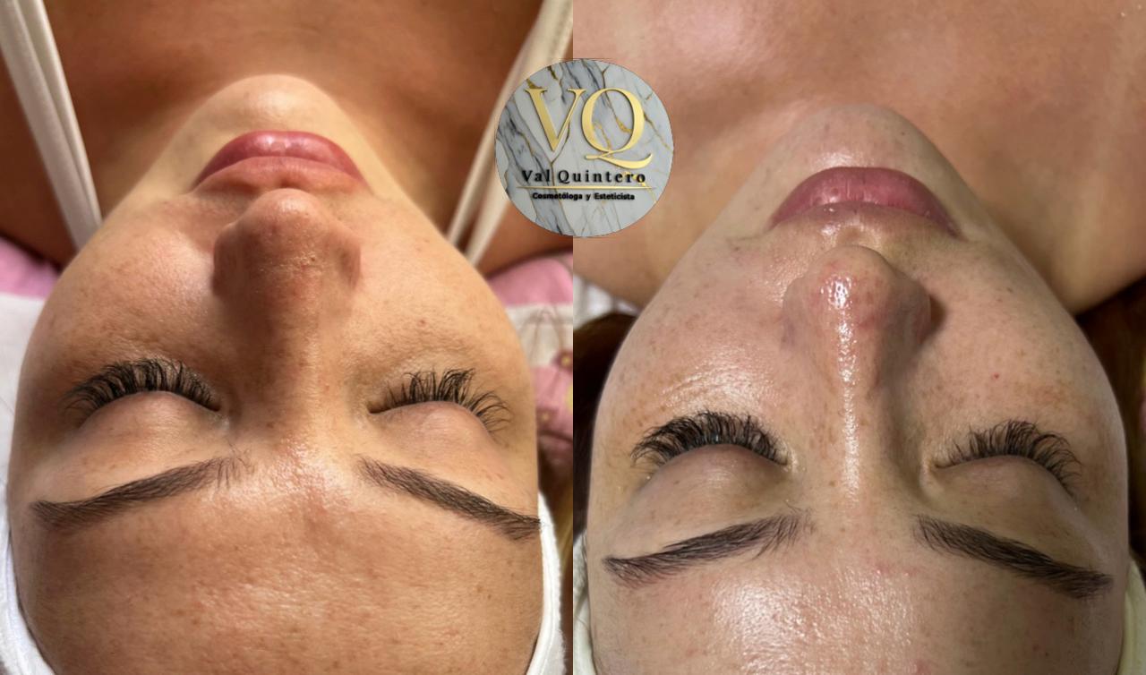 Porcelanización Facial - Val Quintero Cosmetología Medellín