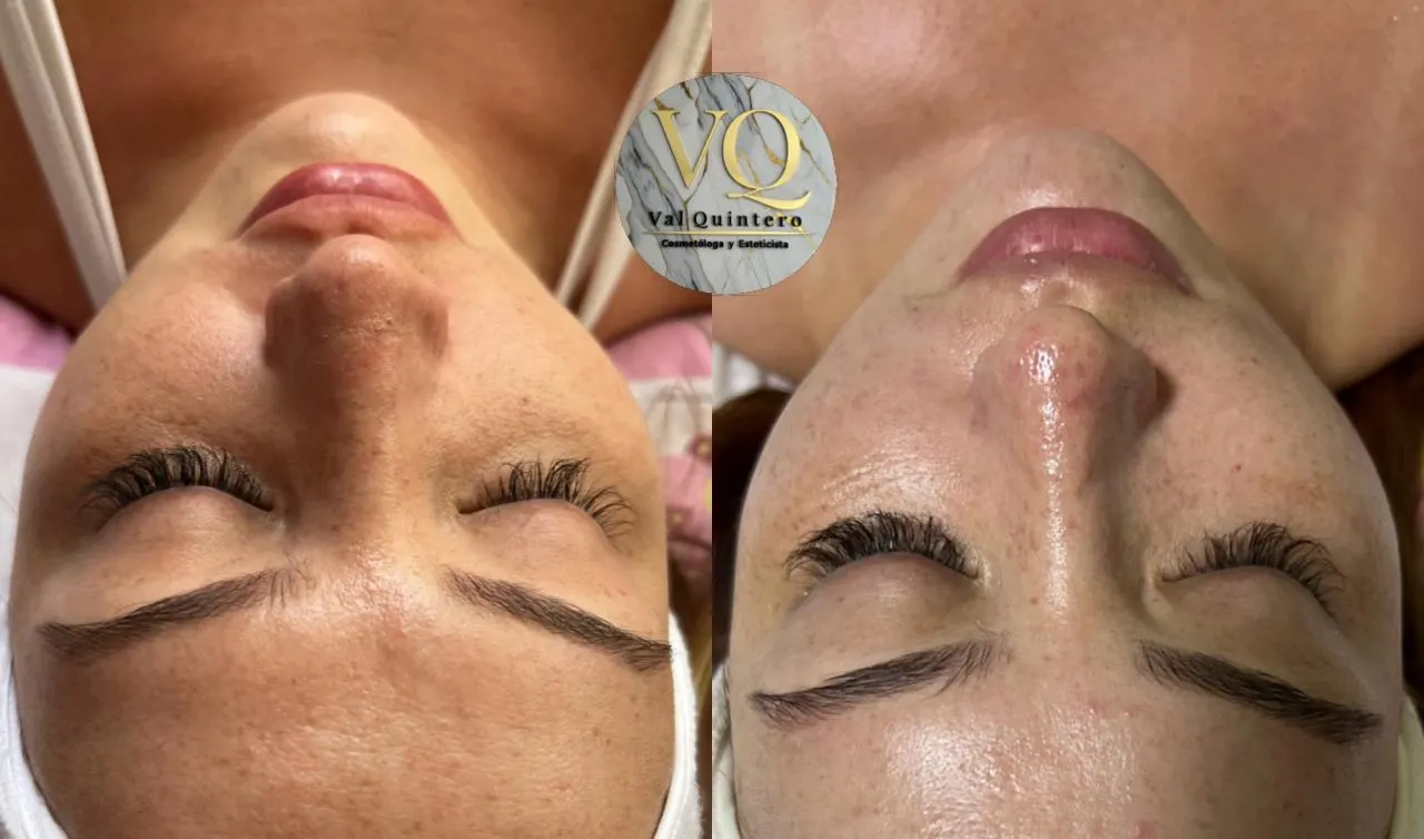 Porcelanización Facial - Val Quintero Cosmetología Medellín