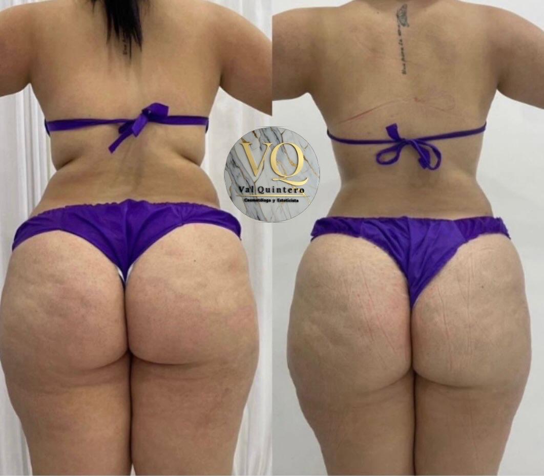 Masajes de Reducción y Moldeo - Val Quintero Cosmetología Medellín